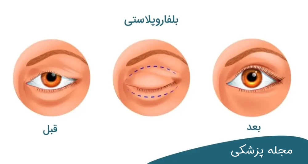 بلفاروپلاستی پلک - dr-mkhansari.com