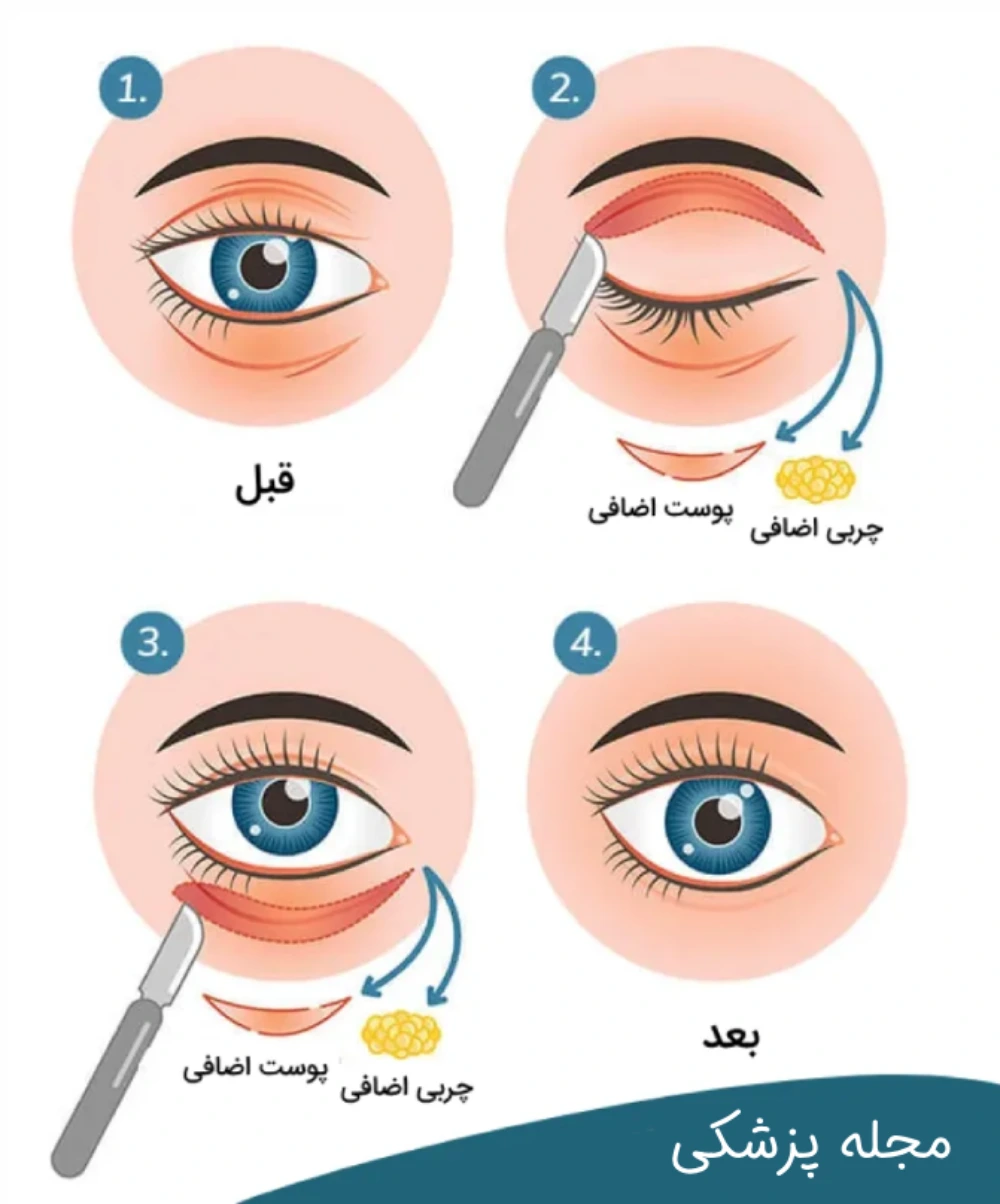 جراحی پلک - dr-mkhansari.com
