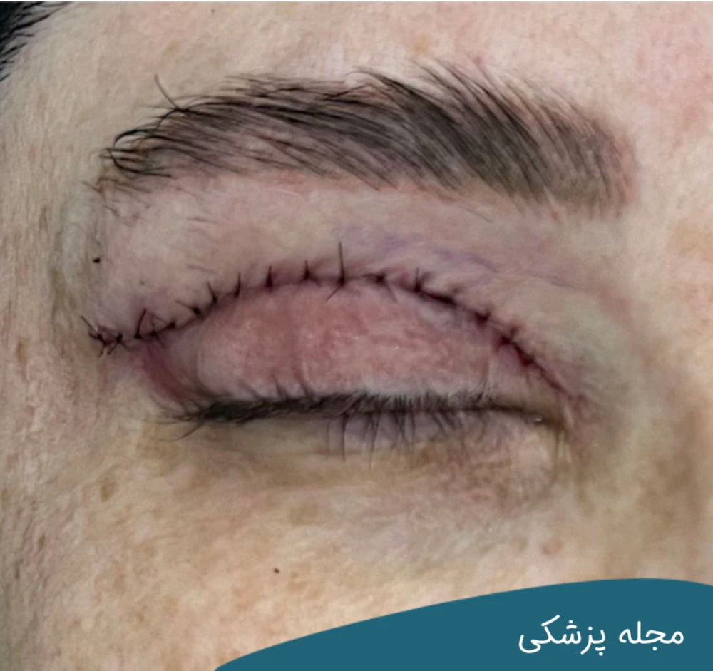 مراقبت های بعد از عمل بلفاروپلاستی-دکتر خوانساری