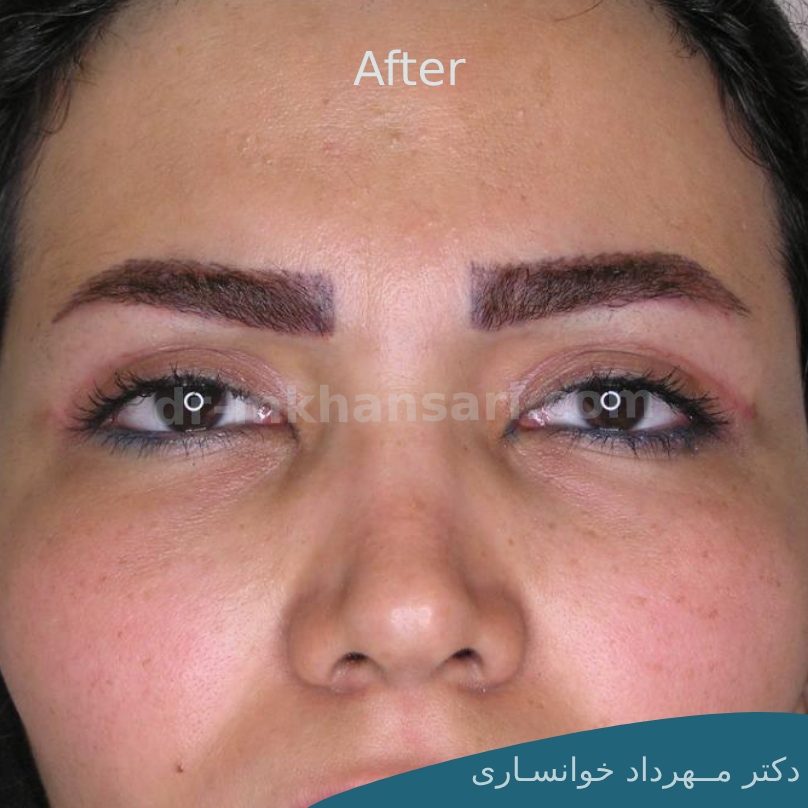 جراحی پلک افتاده-dr-mkhansari.com