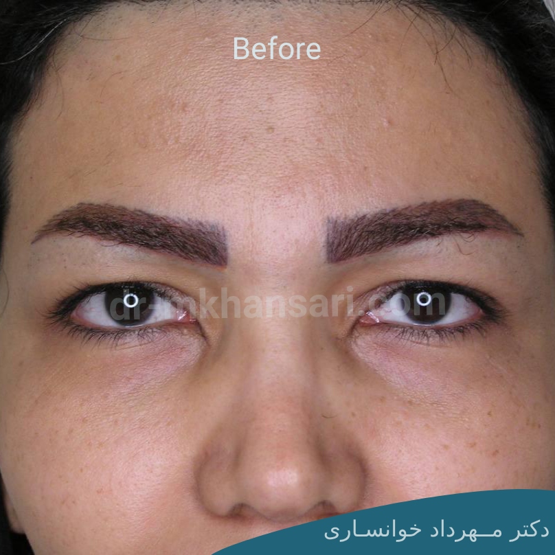 جراحی پلک افتاده-dr-mkhansari.com