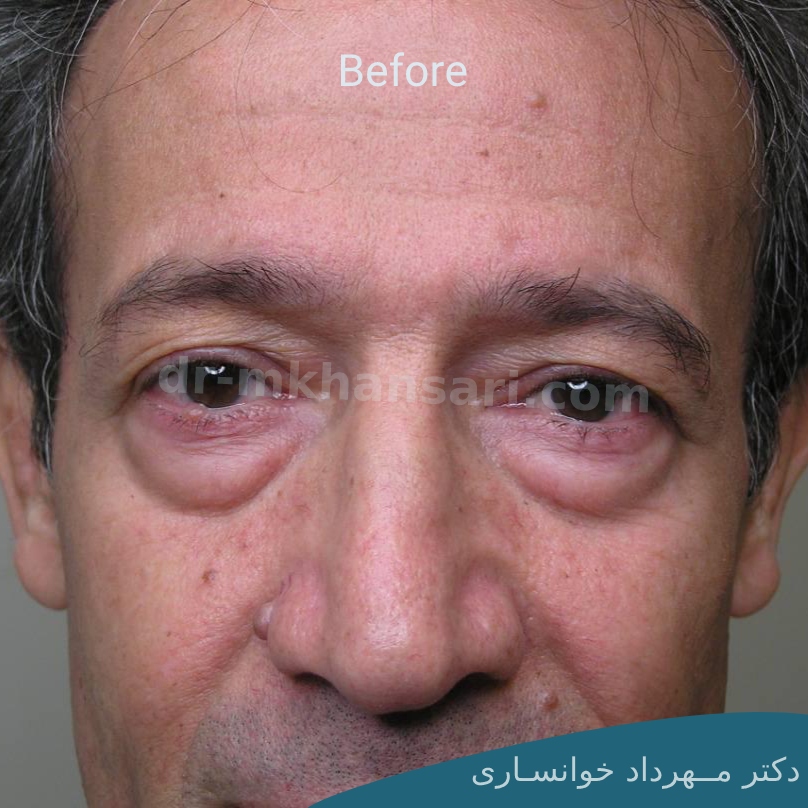 جراحی پلک پایینdr-mkhansari