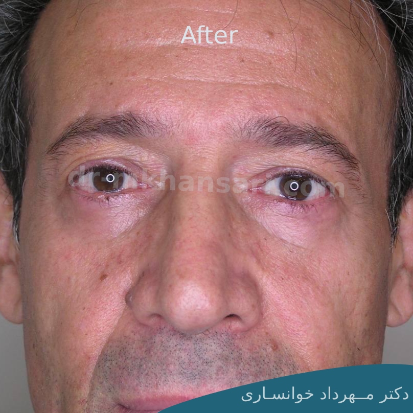 جراحی پلک پایینdr-mkhansari