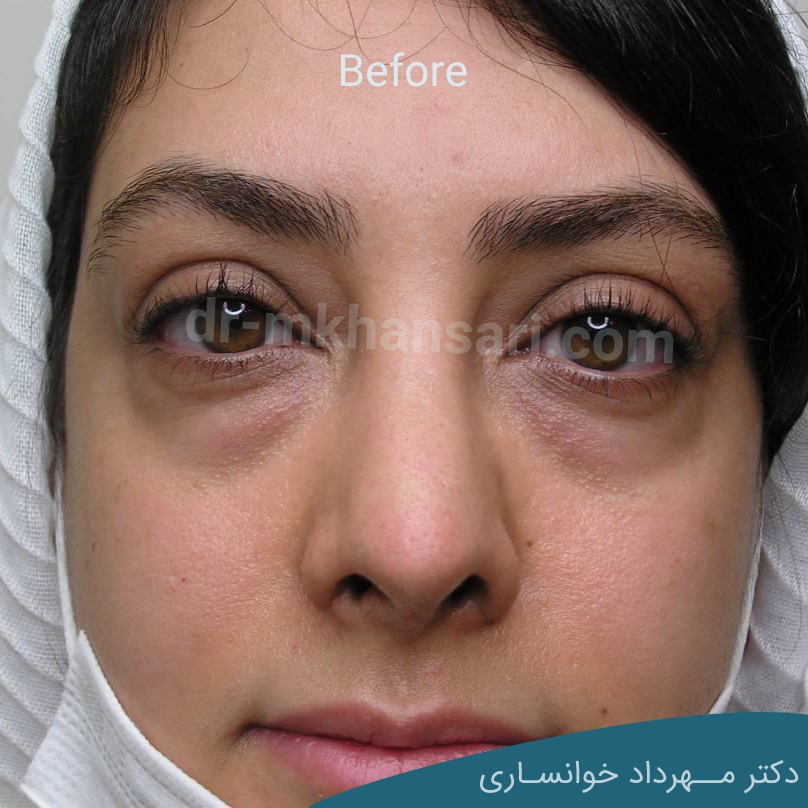 جراحی زیبایی پلک-dr-mkhansari.com
