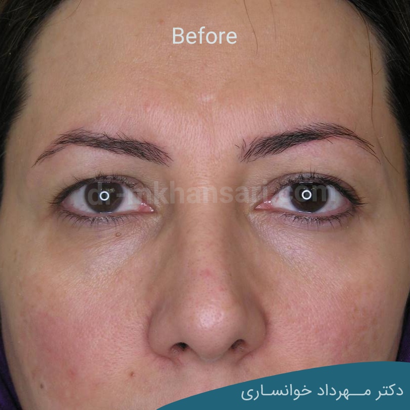 عمل پف چشم-dr-mkhansari.coma