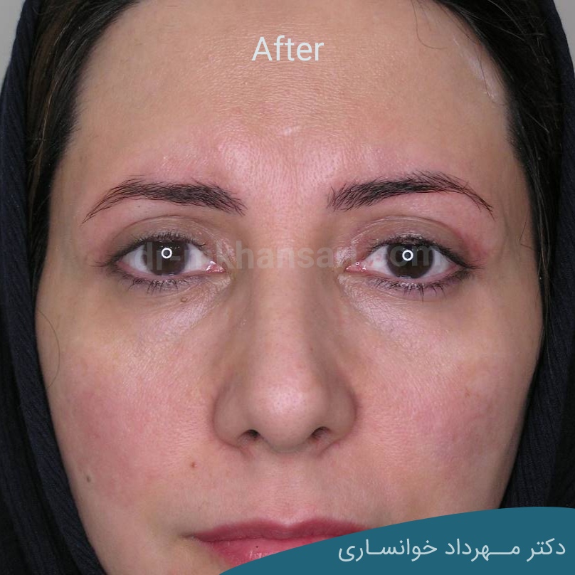 عمل پف چشم-dr-mkhansari.coma