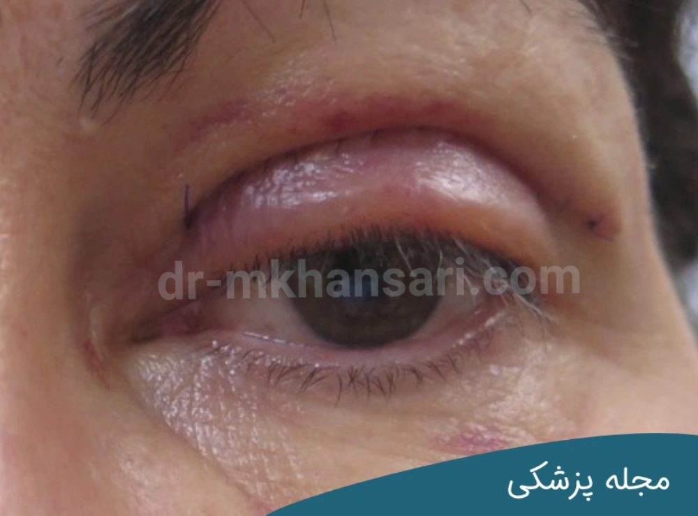 رفع کبودی زیر چشم بعد از عمل بلفاروپلاستیdr-mkhansari