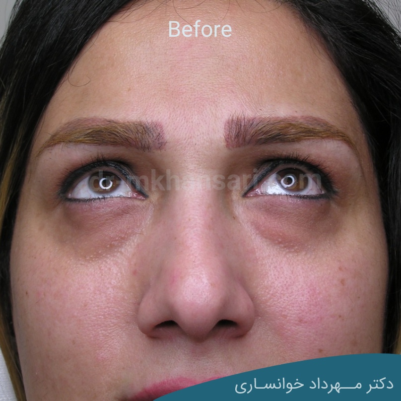عمل پف زیر چشمdr-mkhansari.com
