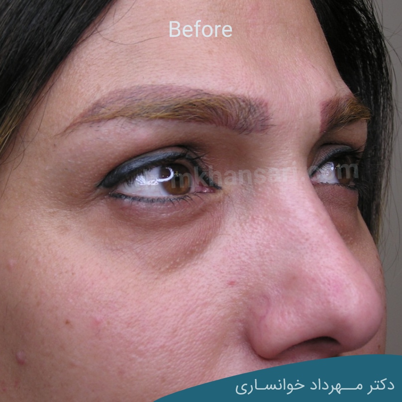 عمل پف زیر چشمdr-mkhansari.com
