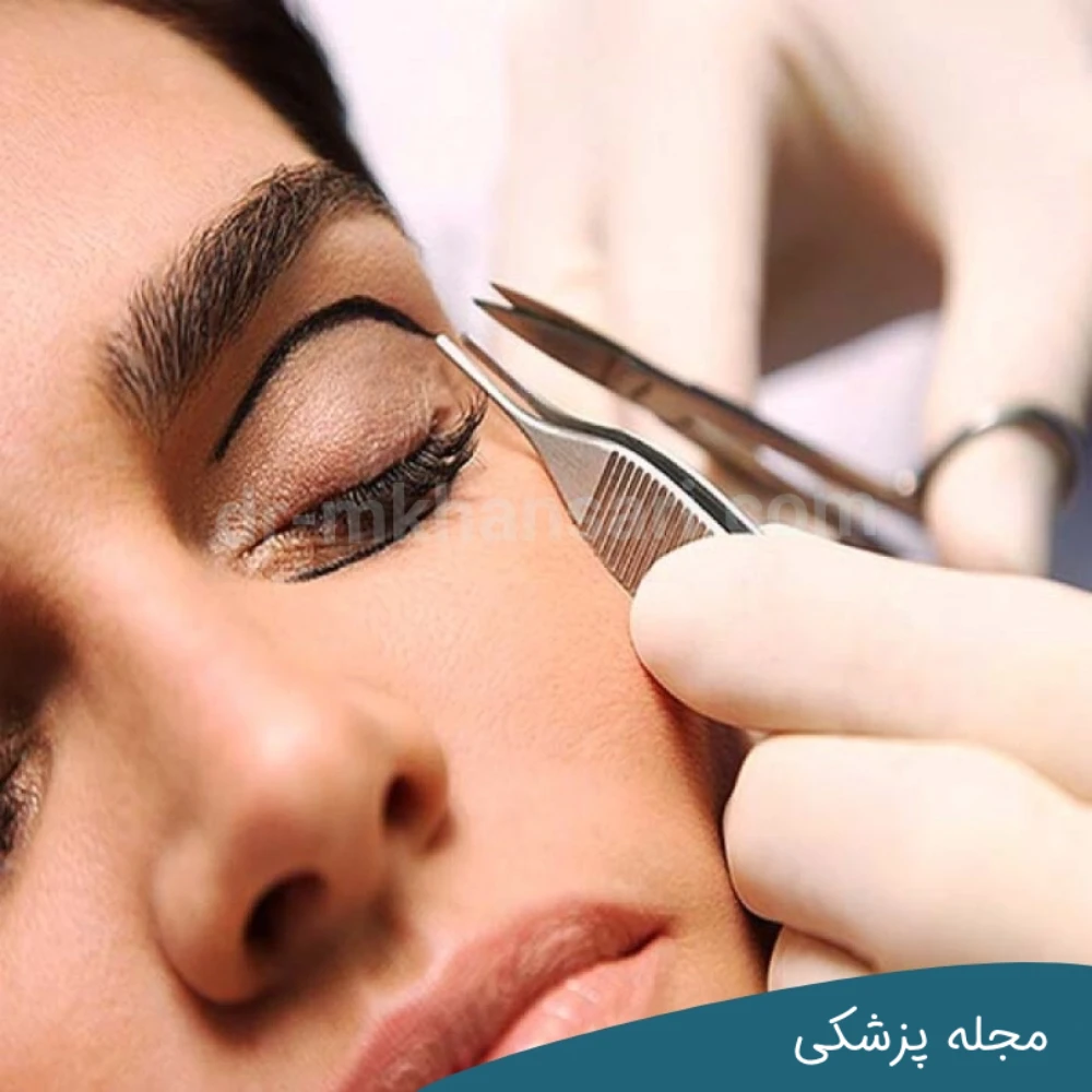مراقبت های بعد از عمل بلفاروپلاستی - dr-mkhansari