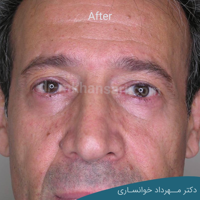 مراقبت های بعد از عمل بلفاروپلاستی-dr-mkhansari.com