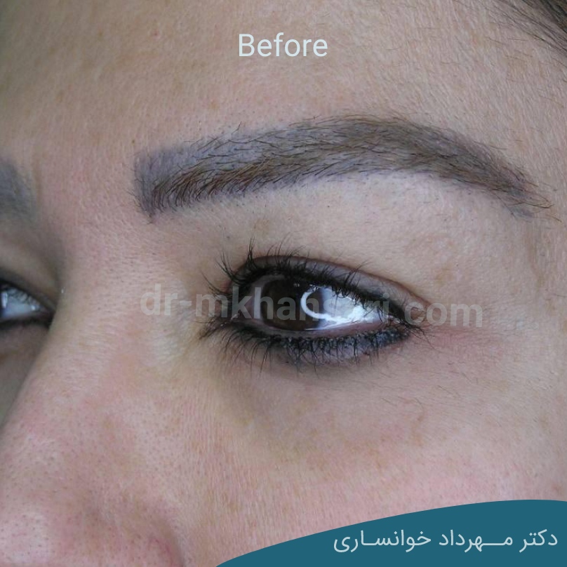عمل زیبایی پلک افتاده-dr-mkhansari.com