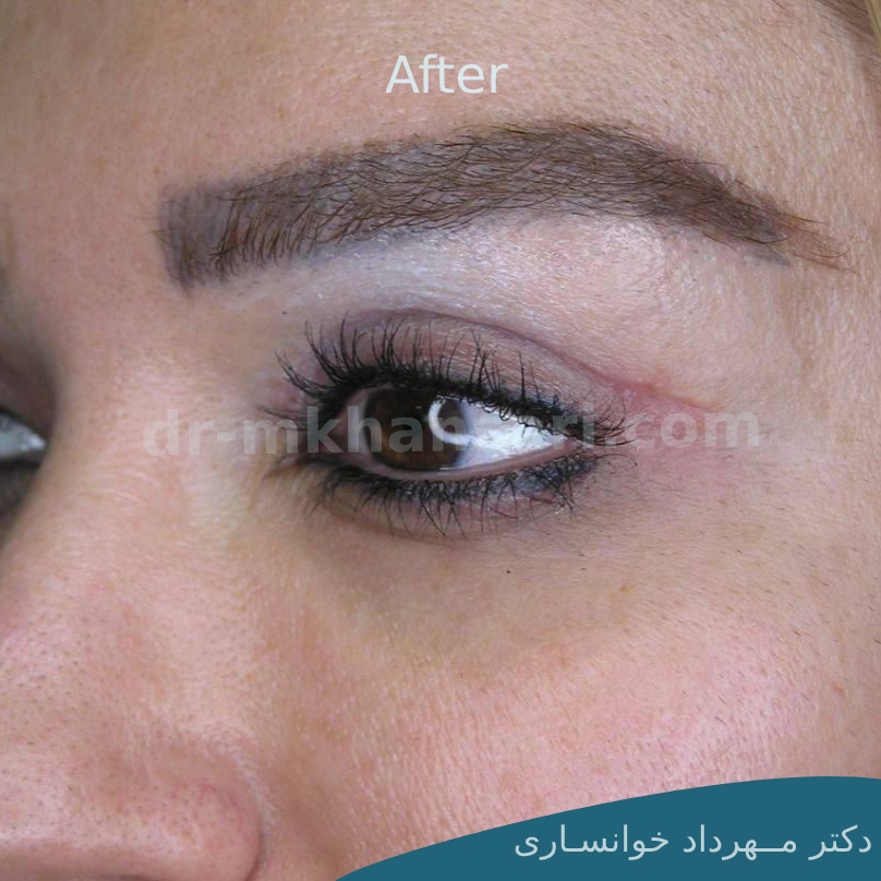 عمل زیبایی پلک افتاده-dr-mkhansari.com