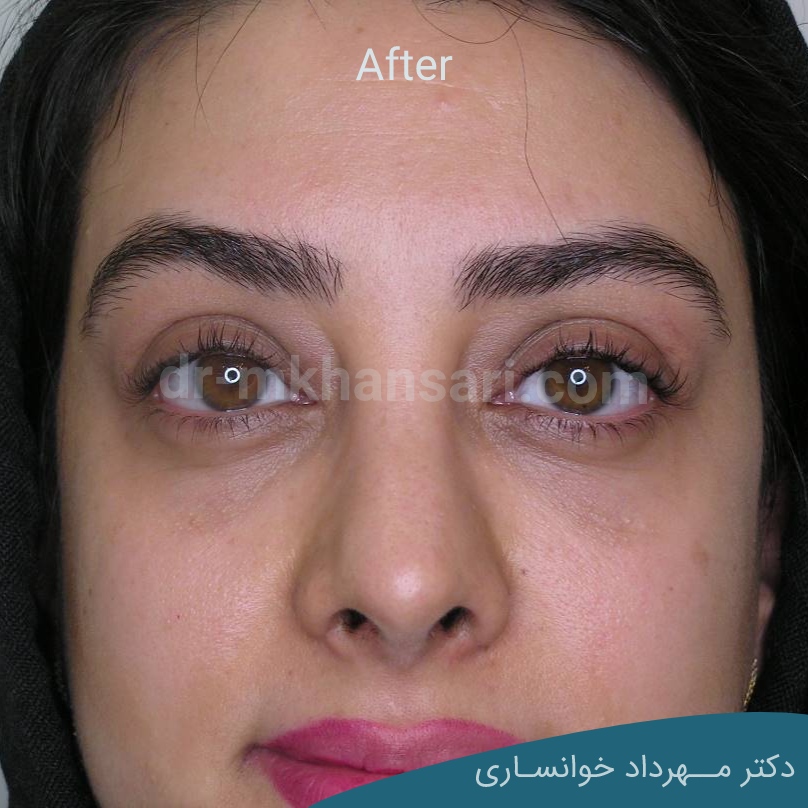 عمل زیبایی پلک-dr-mkhansari.com