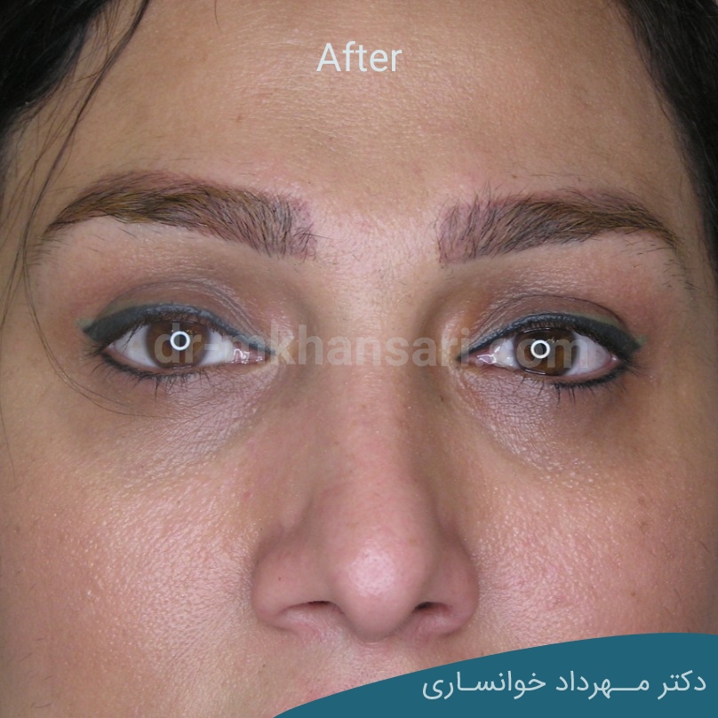 جراحی پف زیر چشمdr-mkhansari.com
