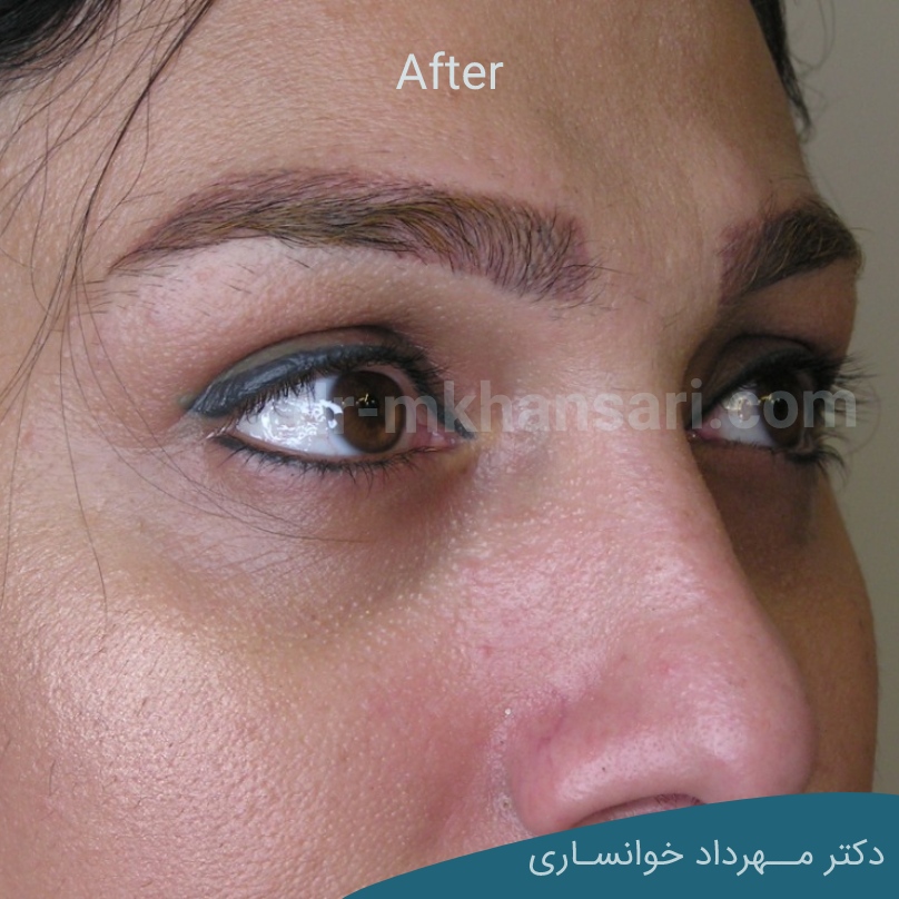 جراحی پف زیر چشمdr-mkhansari.com