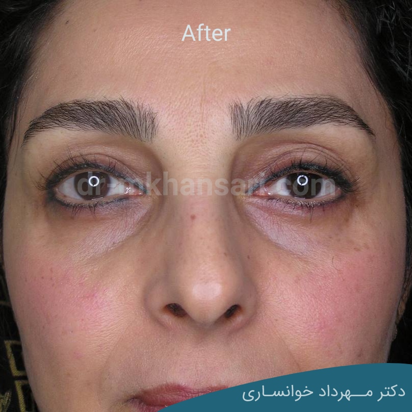 بلفاروپلاستی پلک پایینdr-mkhansari.com