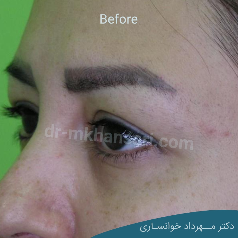برداشتن پف بالای چشم بدون جراحیdr-mkhansari.com