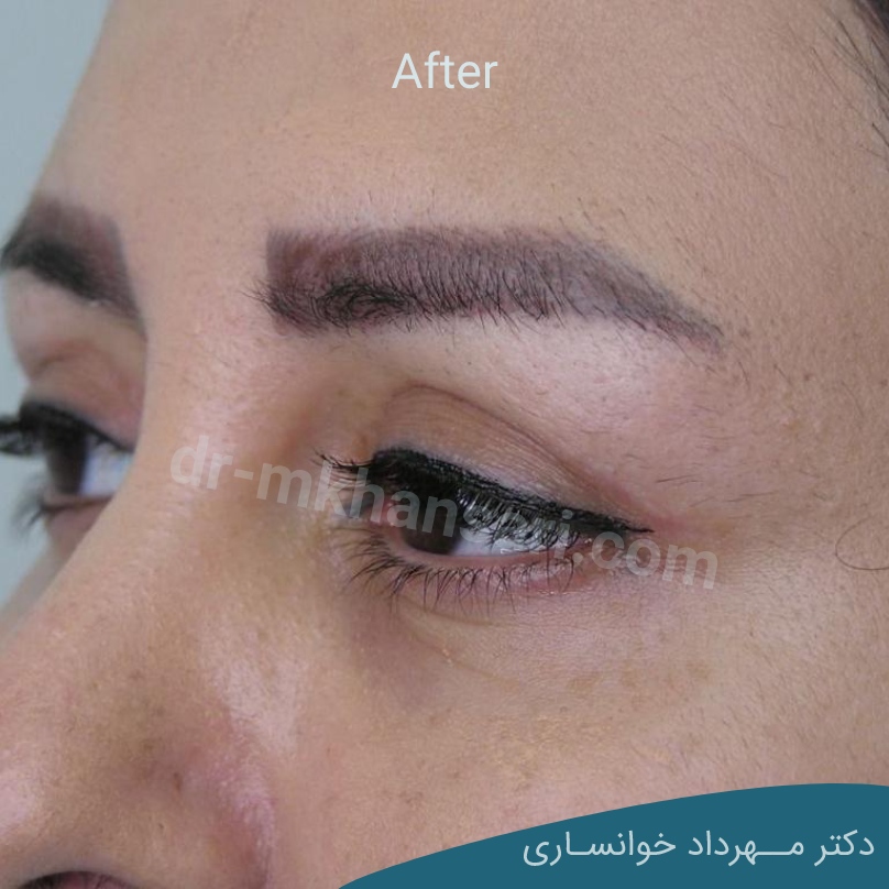 برداشتن پف بالای چشم بدون جراحیdr-mkhansari.com