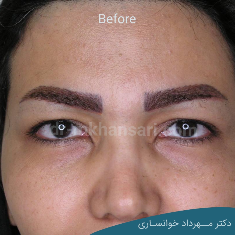 برداشتن پف بالای چشم بدون جراحیdr-mkhansari.com