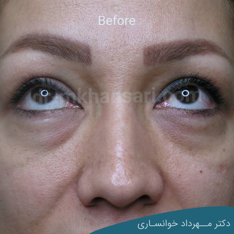 جراحی پلک-dr-mkhansari