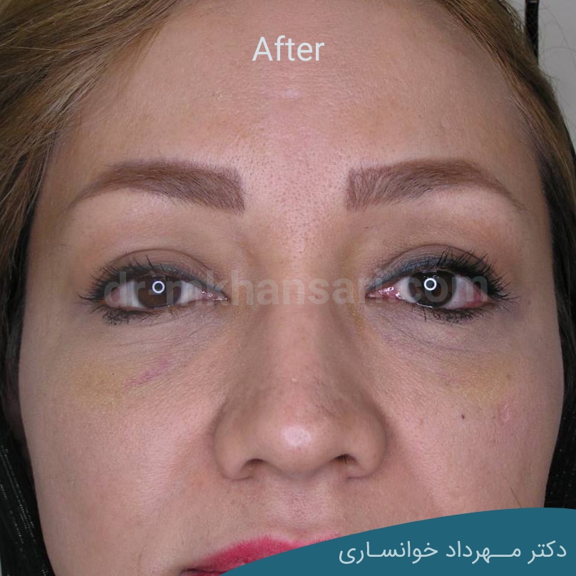 جراحی پلک-dr-mkhansari