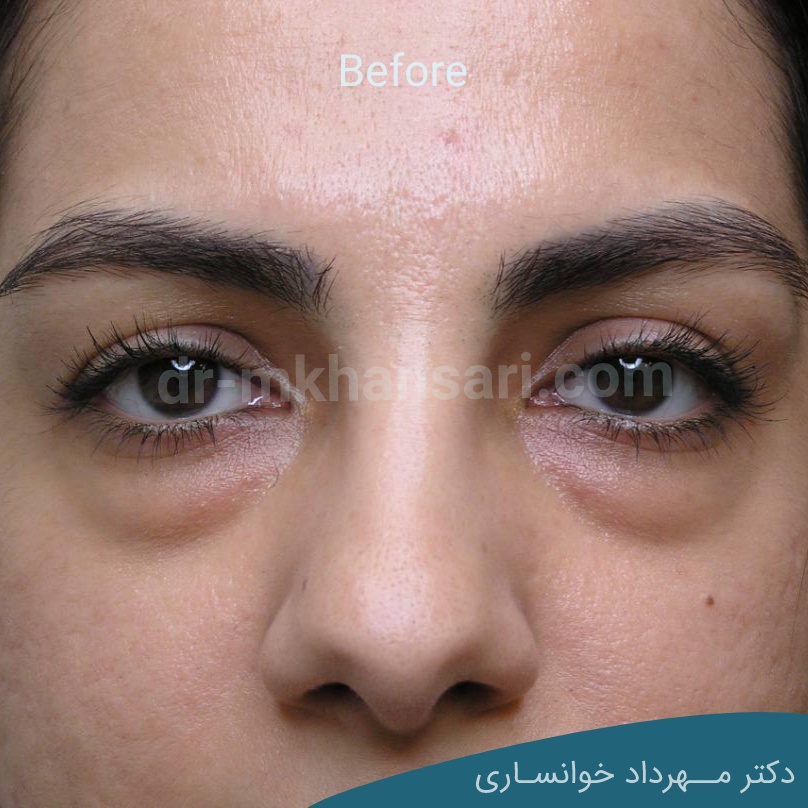 جراحی پلک پایین-dr-mkhansari.com