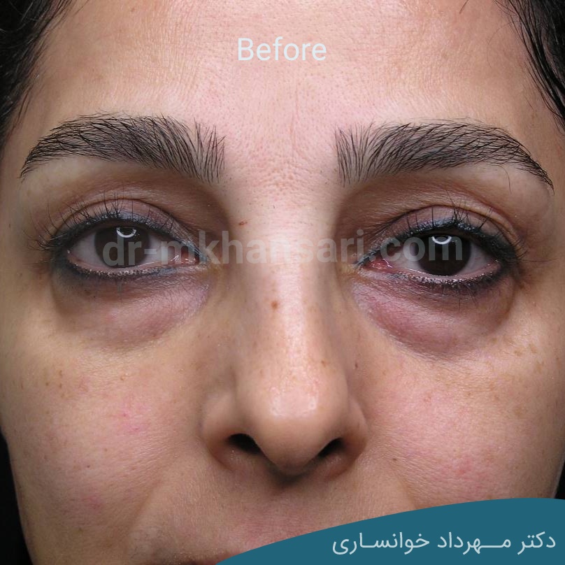 جراحی پلک پایین-dr-mkhansari.com