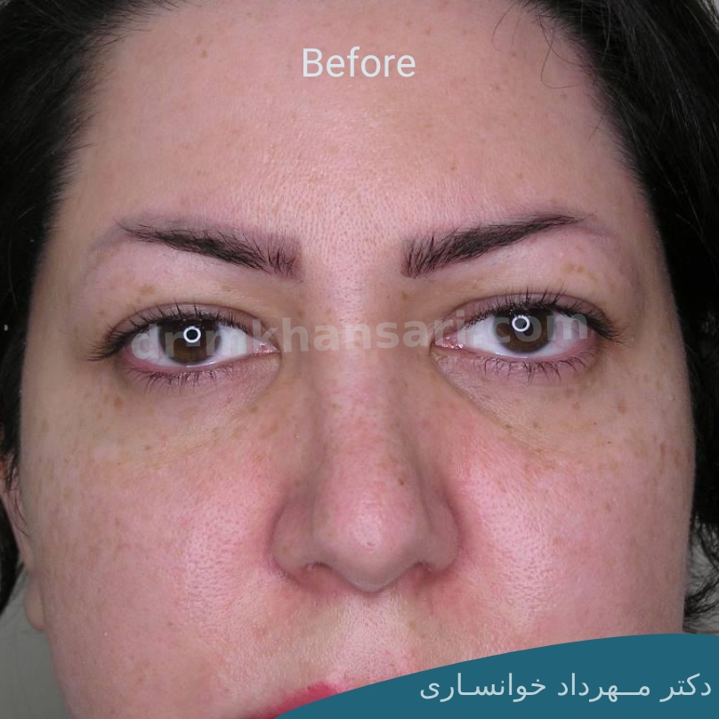 برداشتن پف بالای چشم بدون جراحی-dr-mkhansari