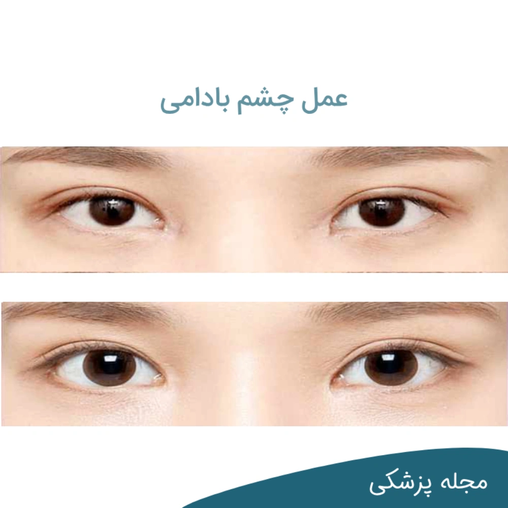 عمل زیبایی چشم - dr-mkhansari.com
