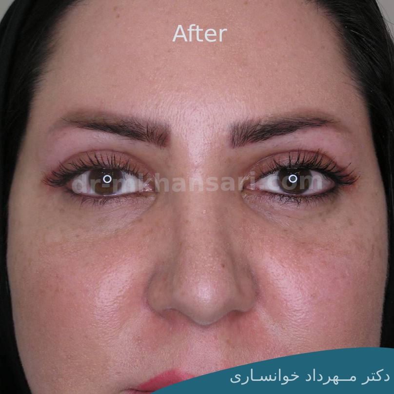 برداشتن پف بالای چشم بدون جراحی-dr-mkhansari