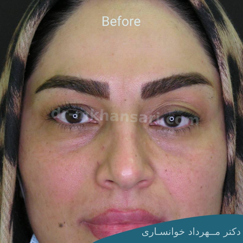 مراقبت های بعد از عمل بلفاروپلاستی-dr-mkhansari