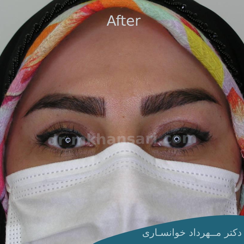 عمل زیبایی چشم-dr-mkhansari.com