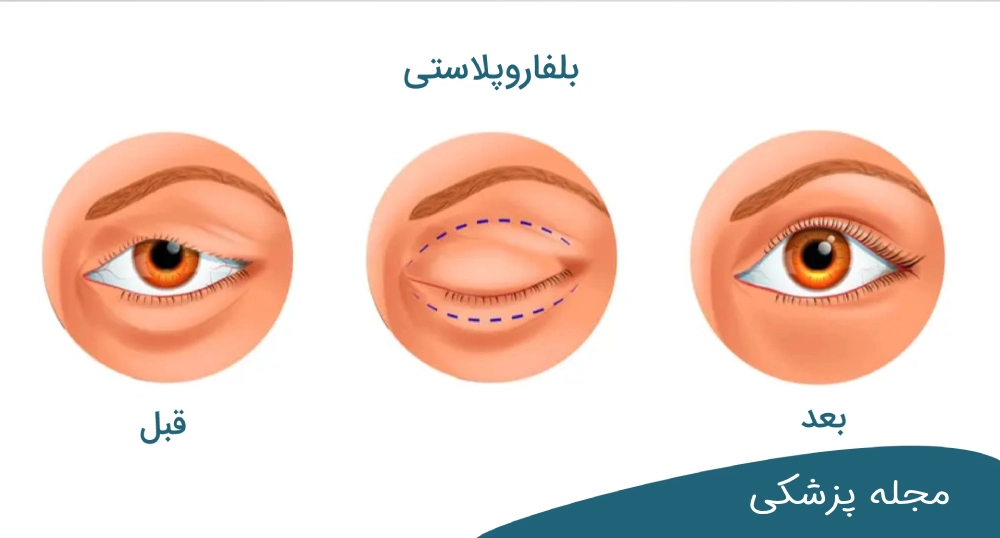 هزینه جراحی پلک افتاده dr-mkhansari