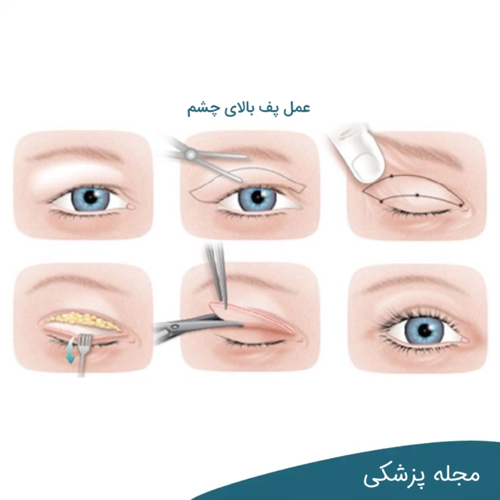 عمل بلفاروپلاستی پلک بالا dr-mkhansari