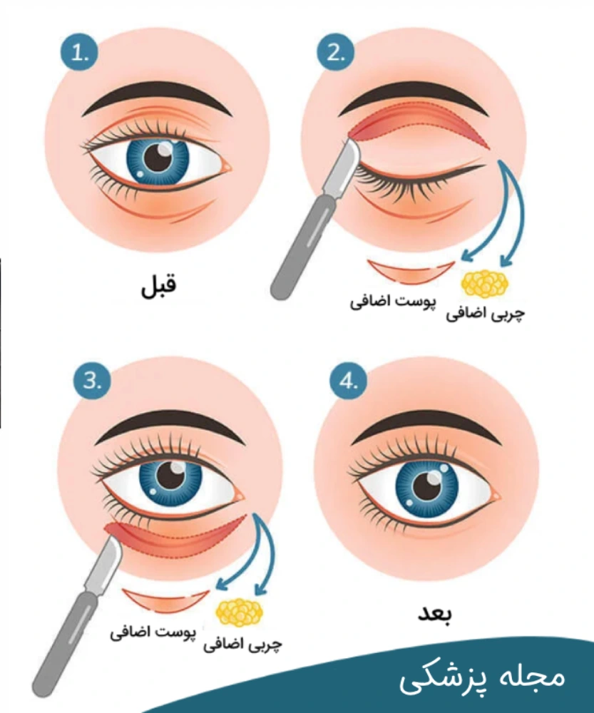 هزینه جراحی افتادگی پلک - dr-mkhansari.com
