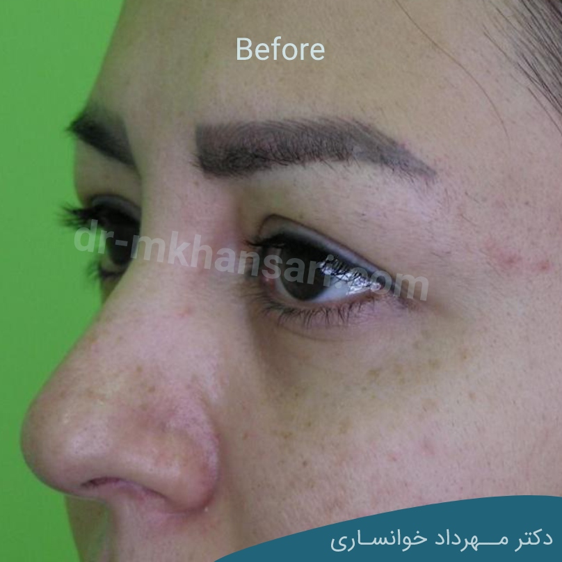 عمل پف بالای چشم-dr-mkhansari