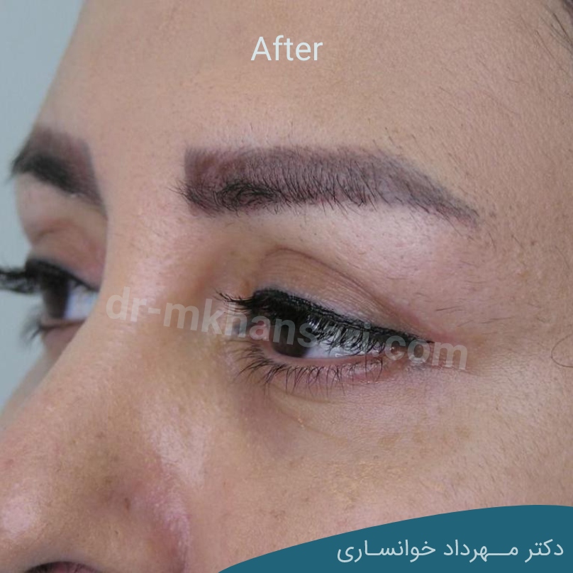 جراحی پلک بالا-mkhansari