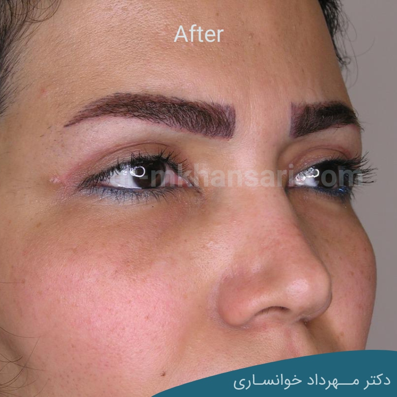 عمل پف بالای چشم-dr-mkhansari