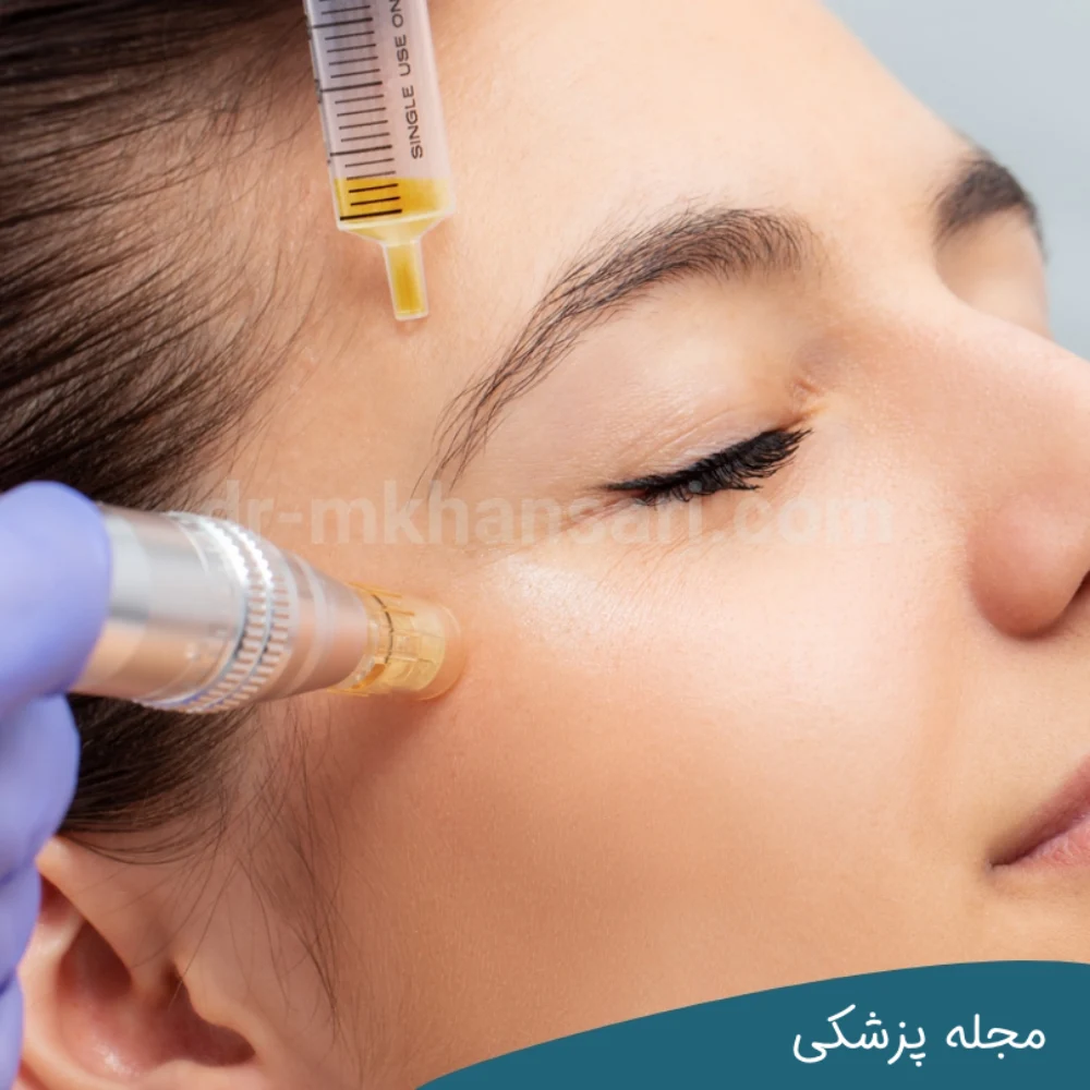 درمان افتادگی پلک بدون درد-dr-mkhansari