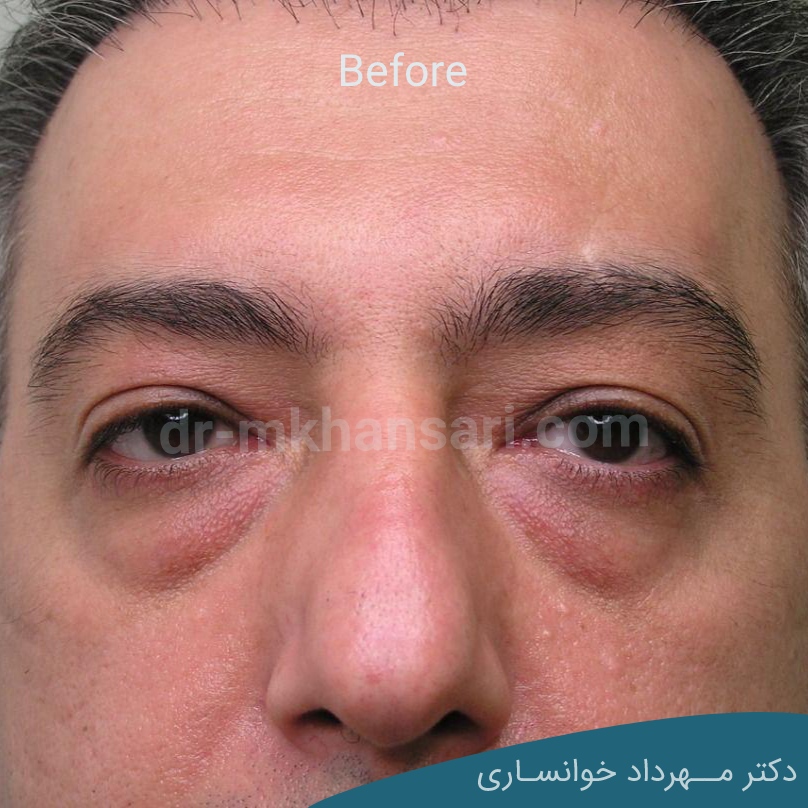هزینه جراحی پلک-dr-mkhansari
