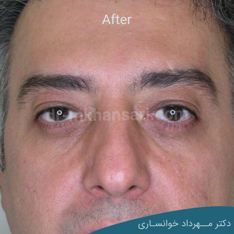 هزینه جراحی پلک-dr-mkhansari