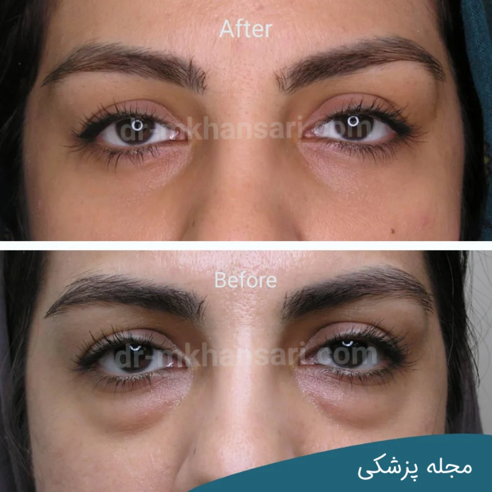 رفع فوری گودی زیر چشم-dr-mkhansari