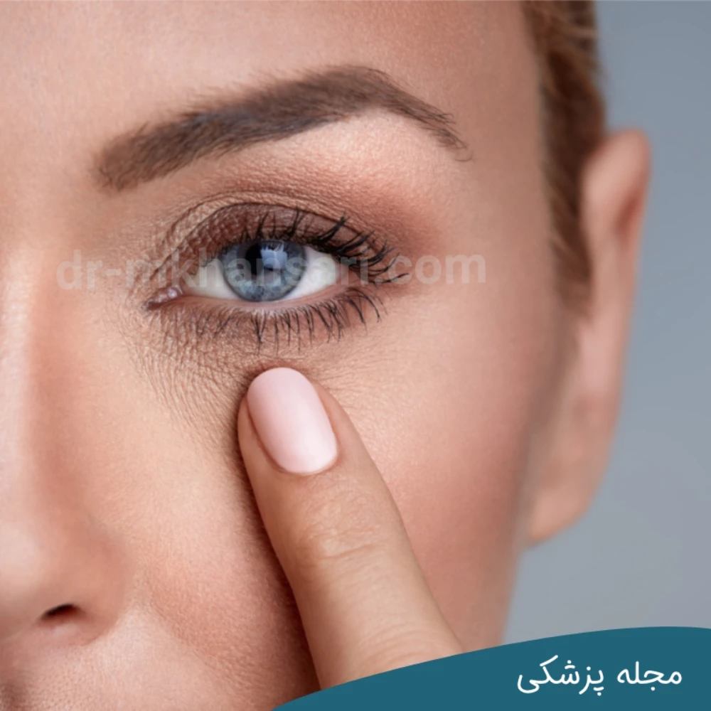 چروک دور چشم ها--dr-mkhansari