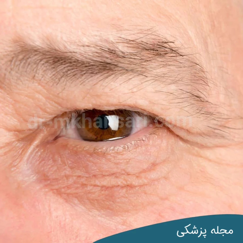 چگونه از چروک دور چشم ها خلاص شویم؟-dr-mkhansari