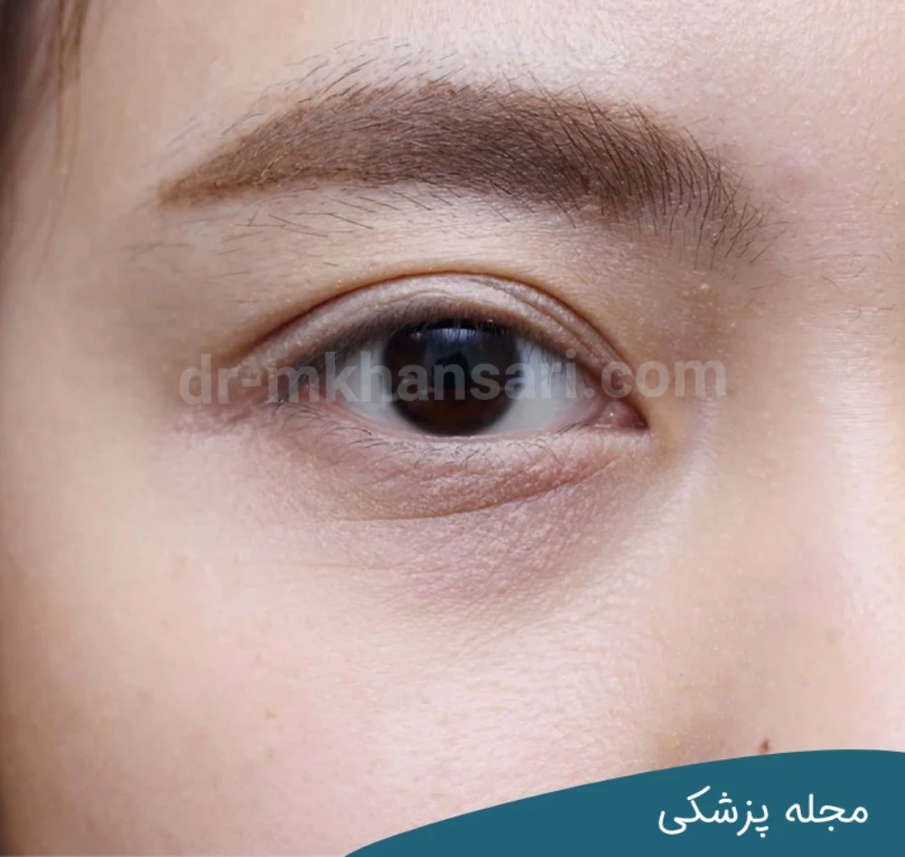 رفع فوری گودی زیر چشم-dr-mkhansari