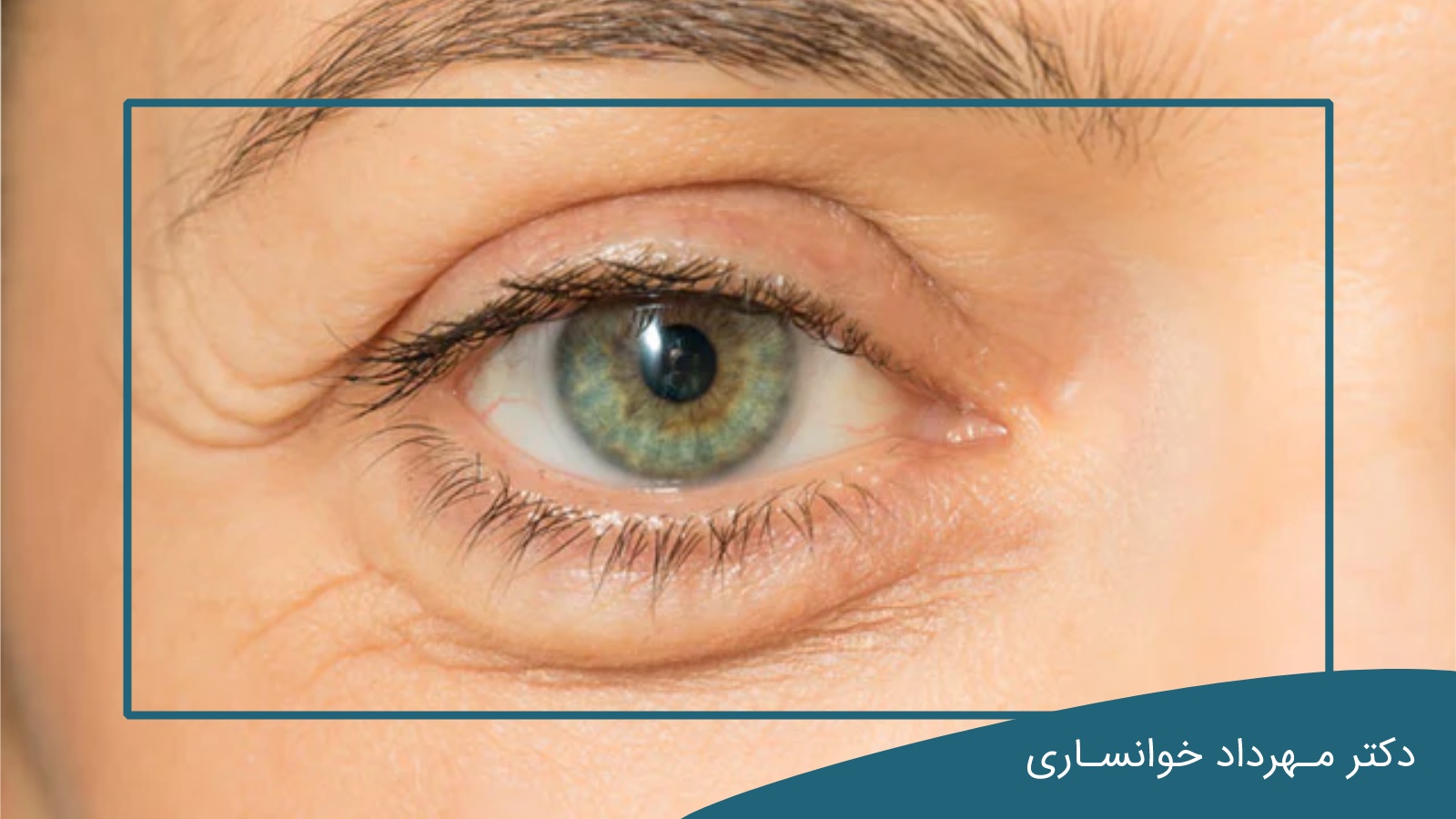 روش های درمان پف چشم-dr-mkhansari