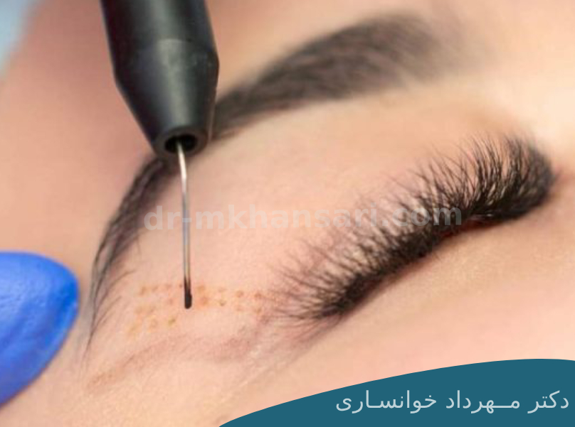 درمان افتادگی پلک با لیزر-dr-mkhansari