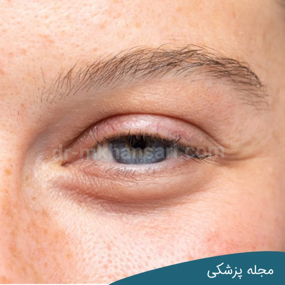 چای کیسه ای برای پف چشم-dr-mkhansari