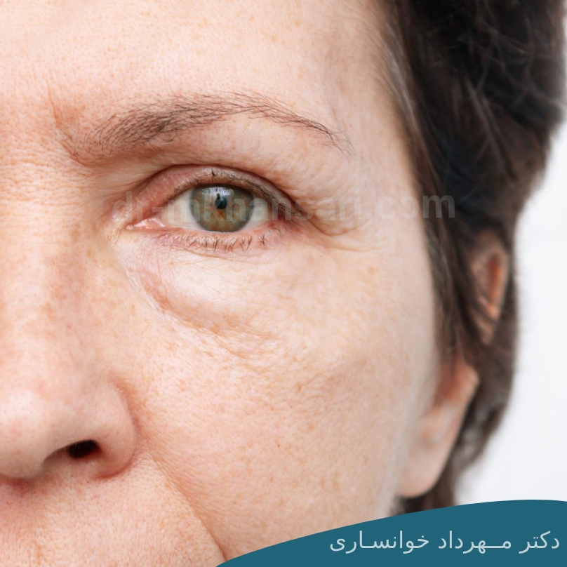 روش های درمان خانگی برای از بین بردن پف زیر چشم-dr-mkhansari